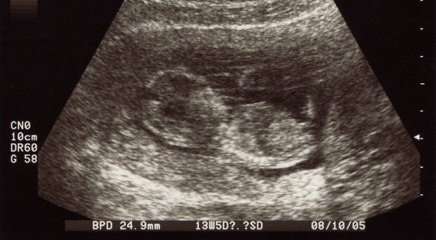ultrasound