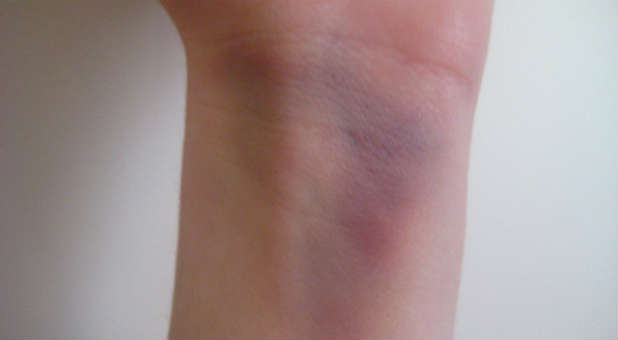 The son had 36 bruises.